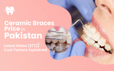 Ceramic Braces Price in Pakistan: Latest 2025 Rates and Cost Factors Explained