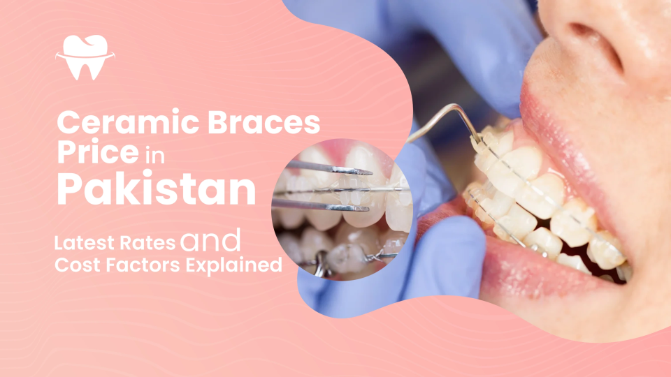 Ceramic Braces Price in Pakistan: Latest 2025 Rates and Cost Factors Explained