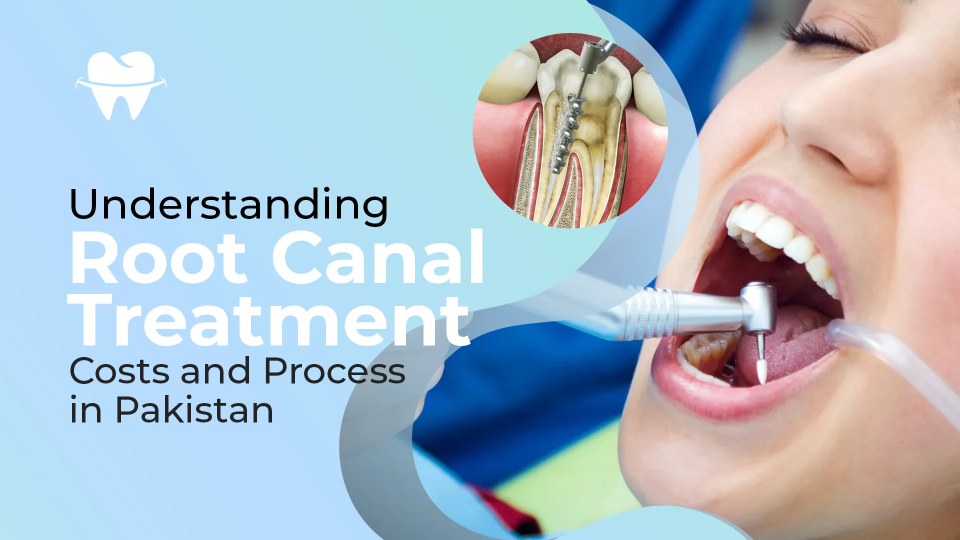 Understanding Root Canal Treatment Costs and Process in Pakistan