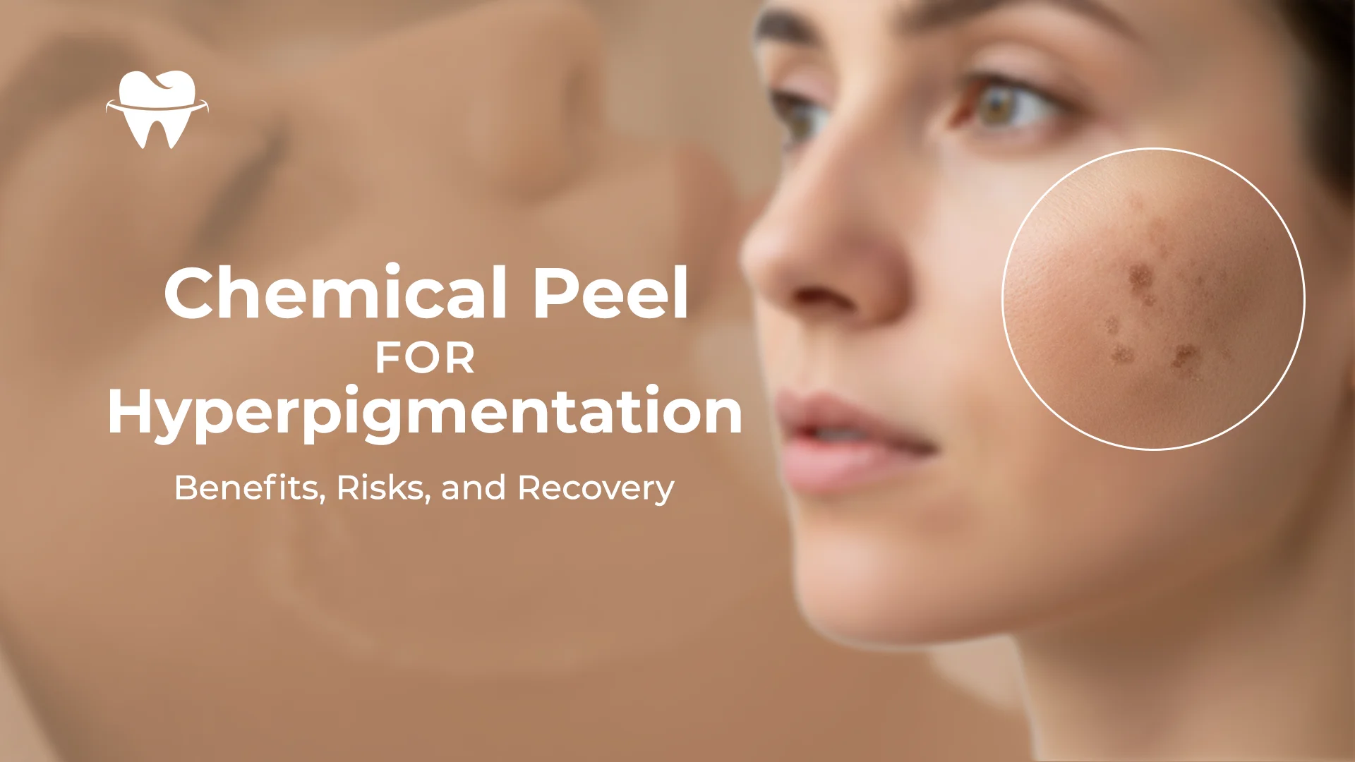 Chemical Peel for Hyperpigmentation