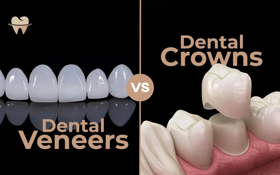 Dental Veneers vs Crowns – A Complete Comparison Guide