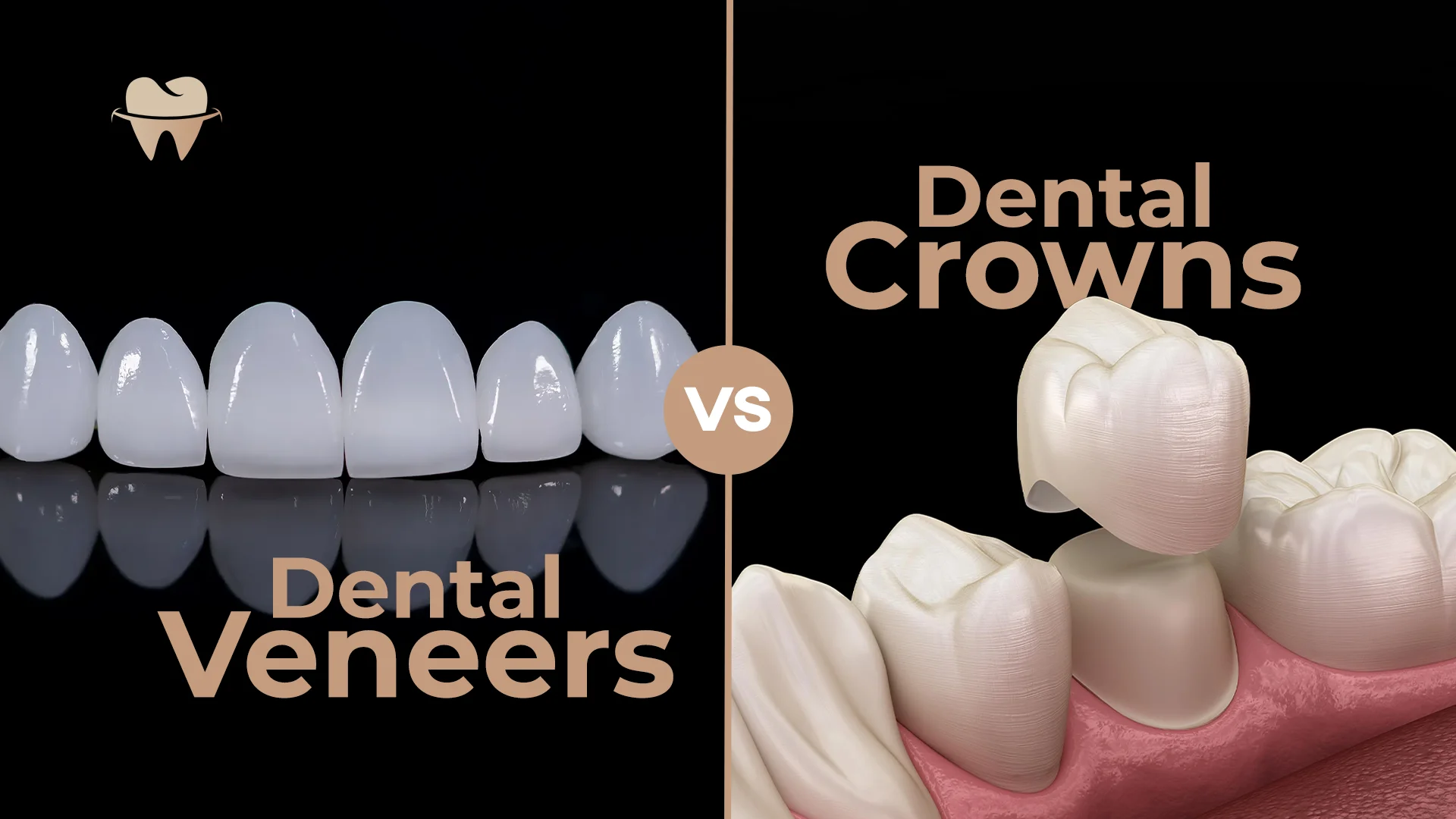 Dental Veneers vs Crowns