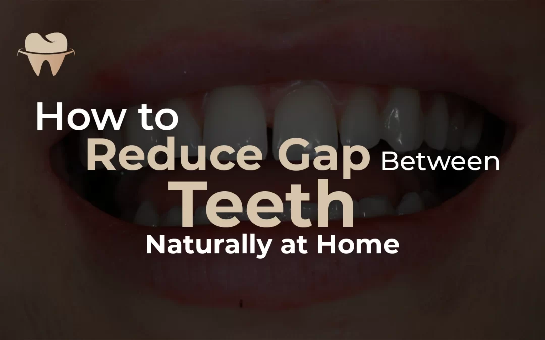 How to Reduce the Gap Between Teeth Naturally at Home
