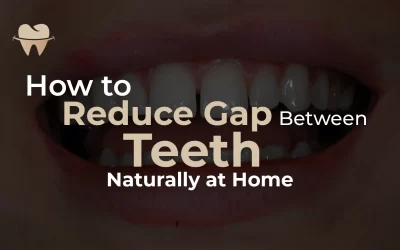 How to Reduce the Gap Between Teeth Naturally at Home