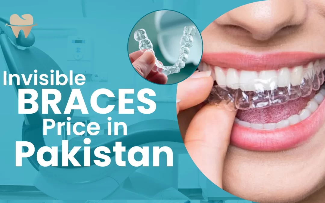 Invisible Braces Price in Pakistan: What to Expect in 2025 and Beyond