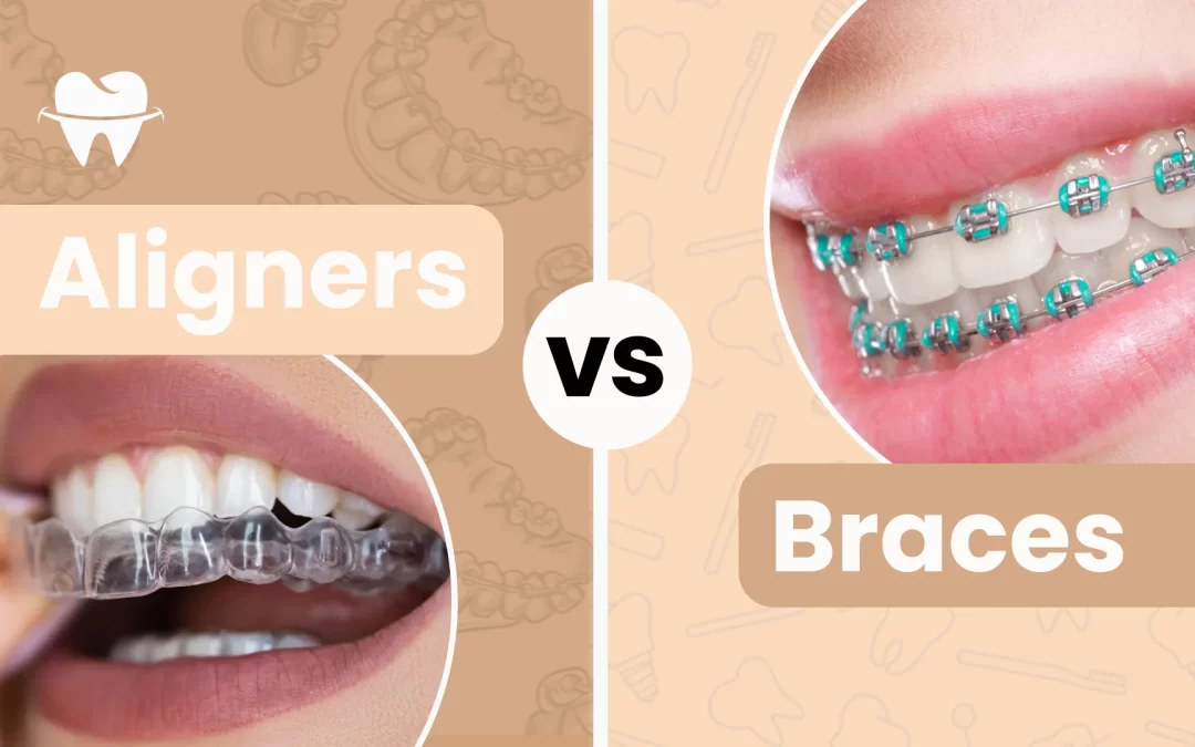 Aligners vs Braces: Which Works Best for Teeth Straightening?