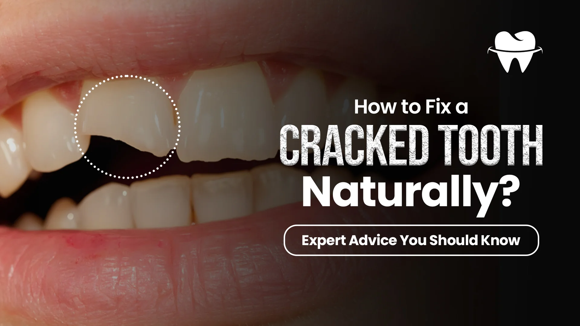 How to Fix a Cracked Tooth Naturally