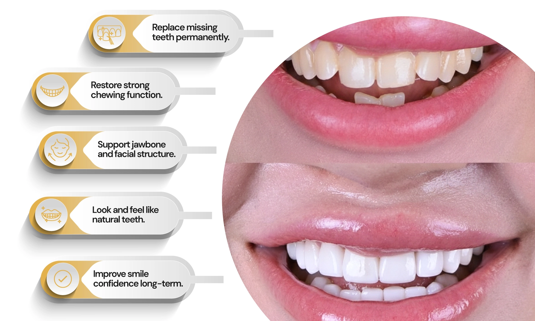 Benefits of Dental Implants