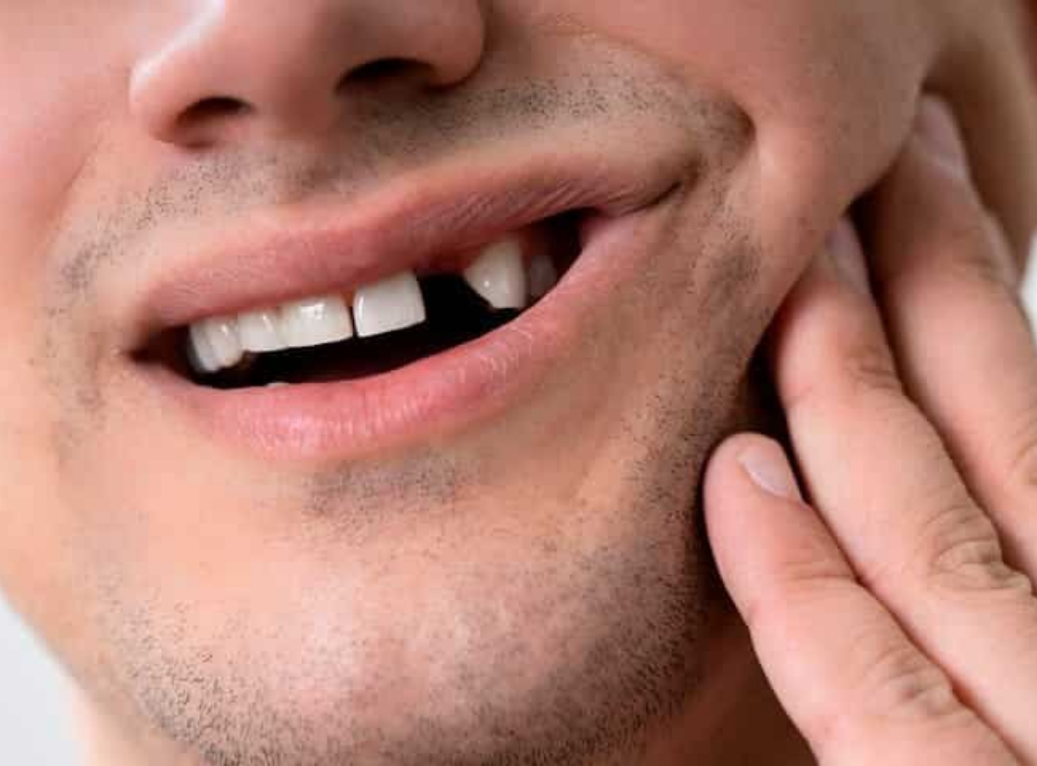 When Should You Consider Dental Implants