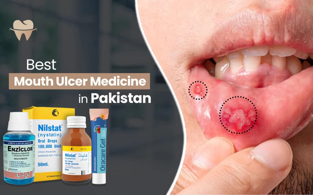 Best Mouth Ulcer Medicine in Pakistan: Top Options Reviewed