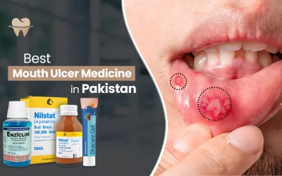 Best Mouth Ulcer Medicine in Pakistan: Top Options Reviewed