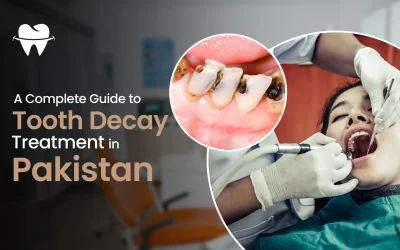 A Complete Guide to Tooth Decay Treatment in Pakistan