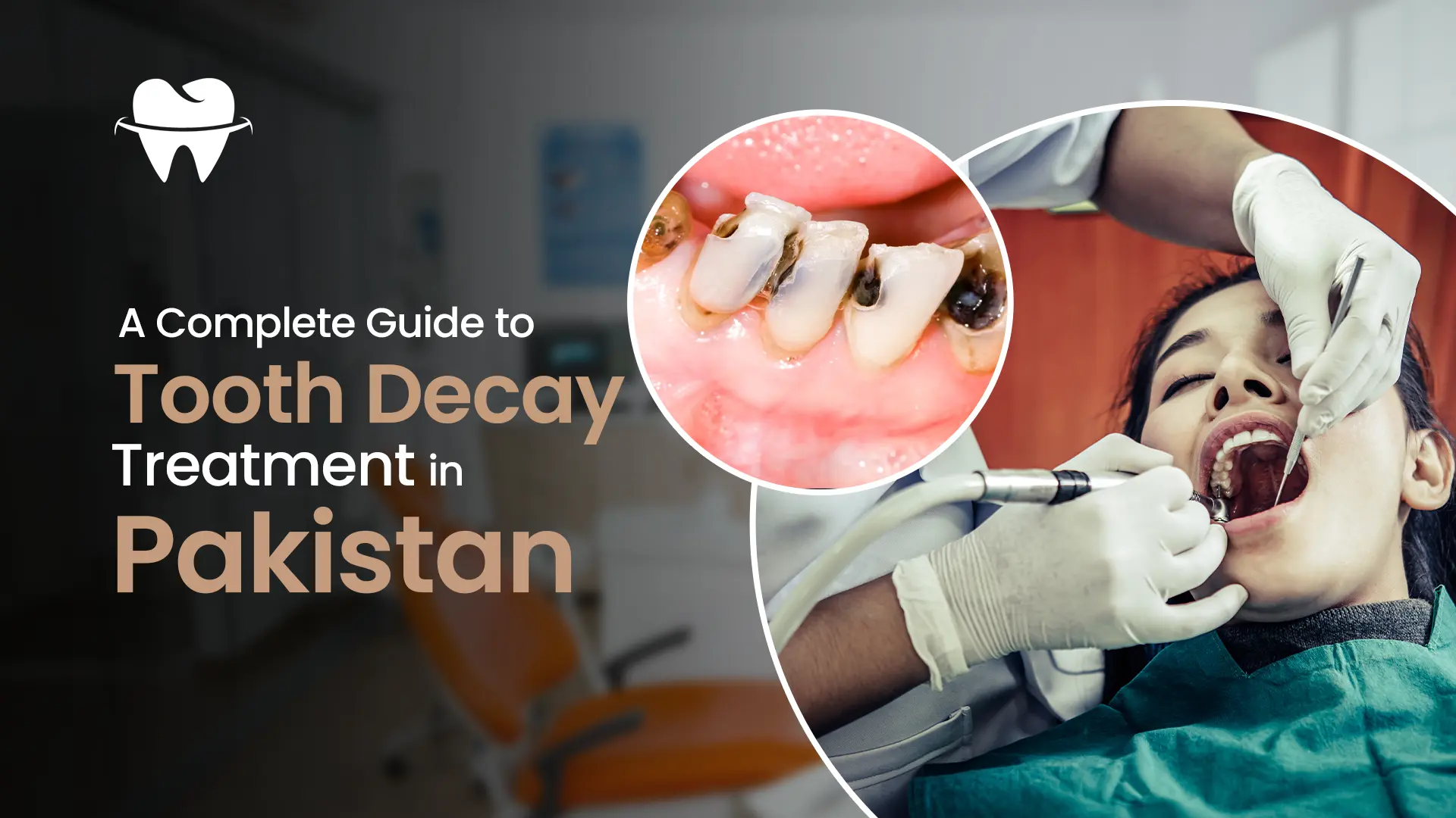 Tooth Decay Treatment in Pakistan