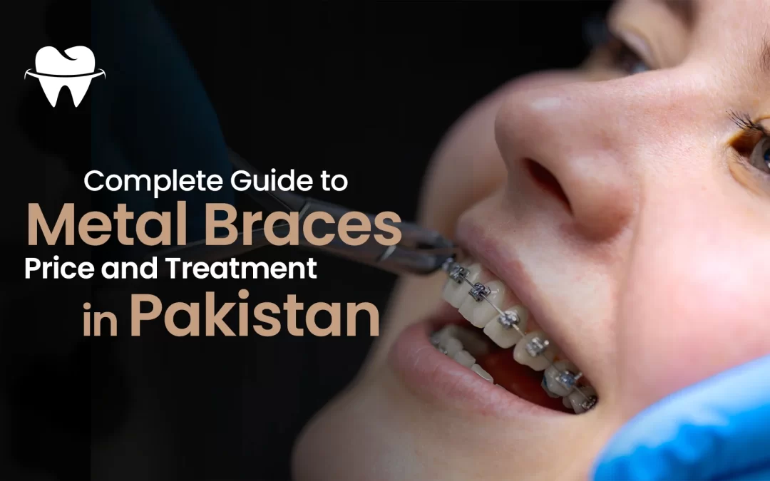 Complete Guide to Metal Braces Price and Treatment in Pakistan