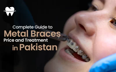 Complete Guide to Metal Braces Price and Treatment in Pakistan