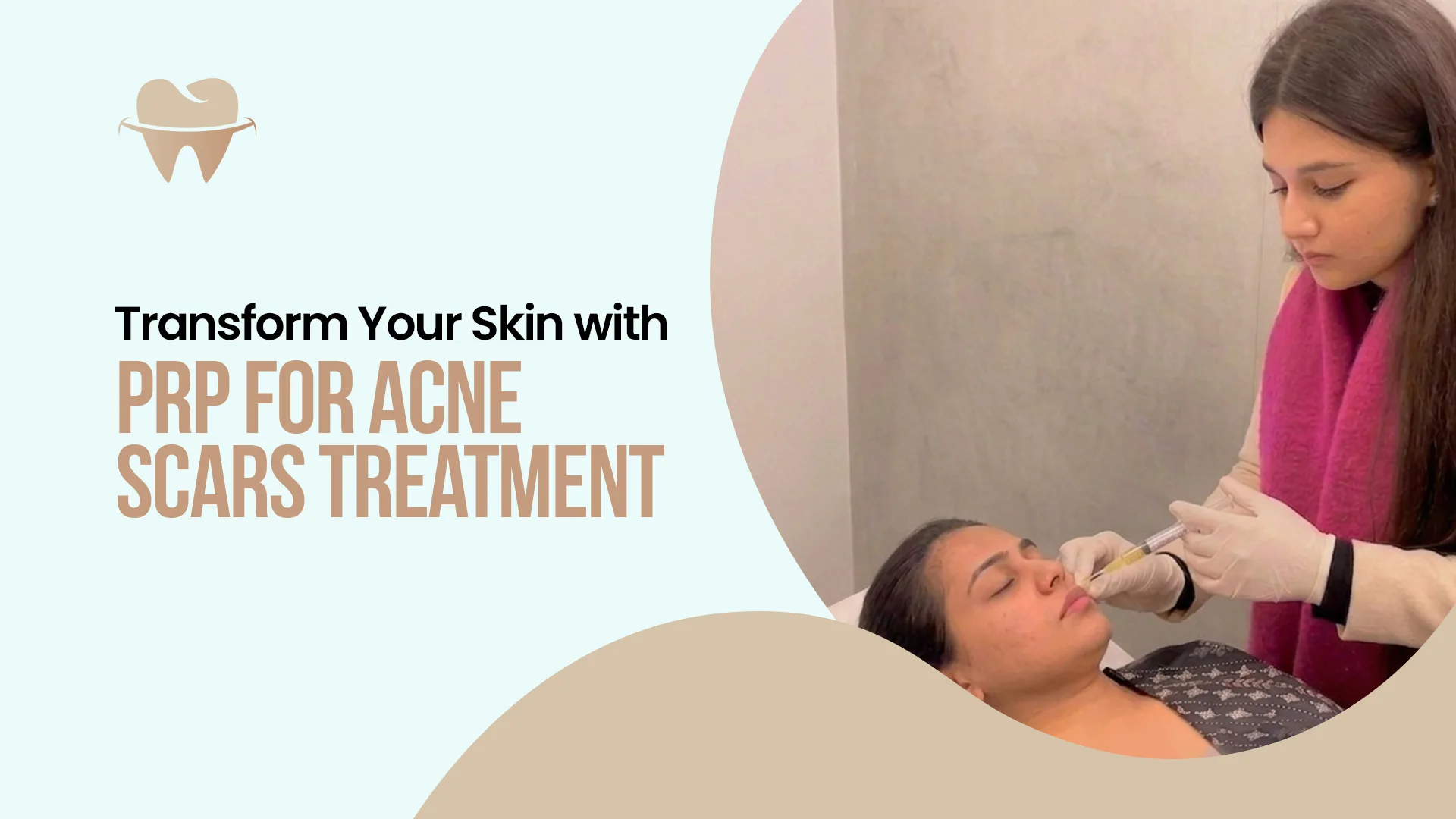 PRP for Acne Scars
