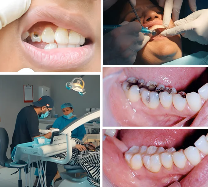 Exploring Teeth Filling Treatment