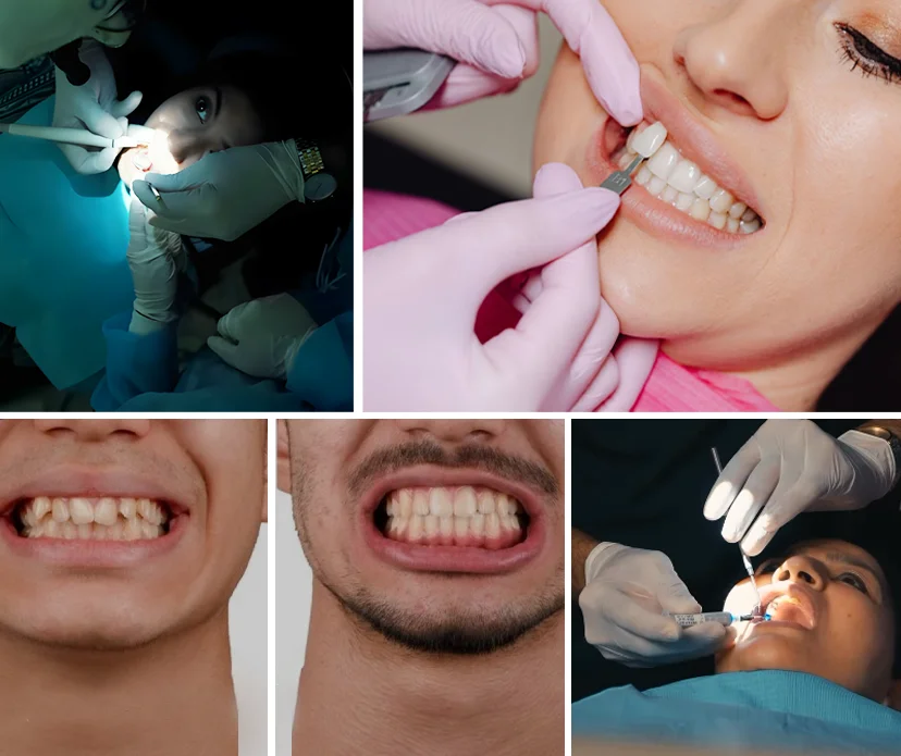 Exploring Teeth Veneers