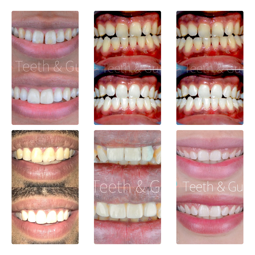 Teeth Whitening