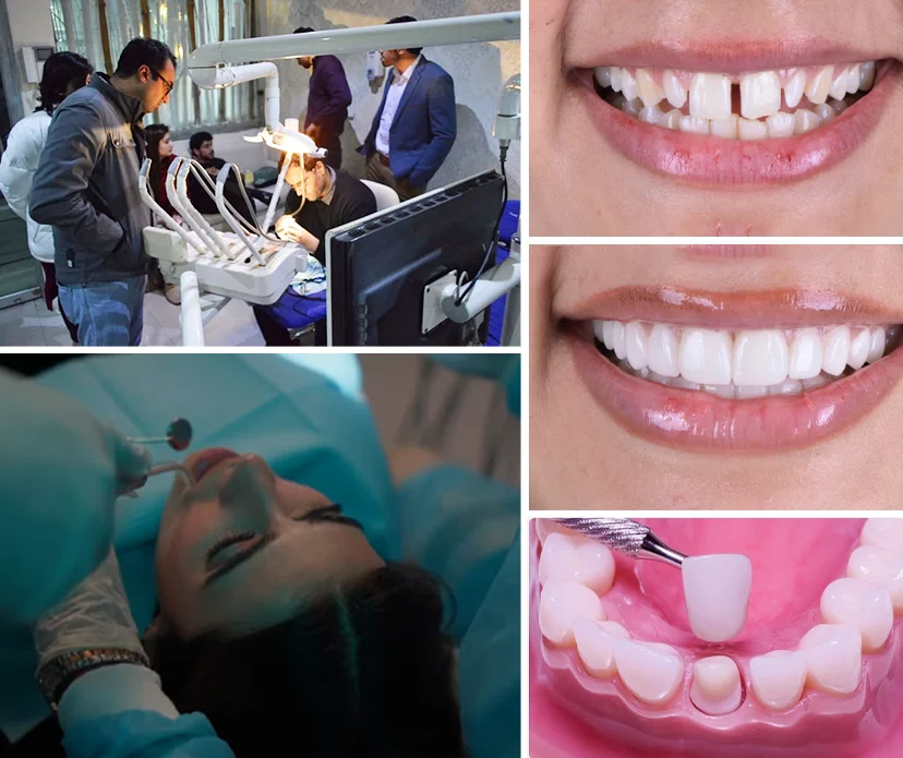 Understanding Teeth Crowns