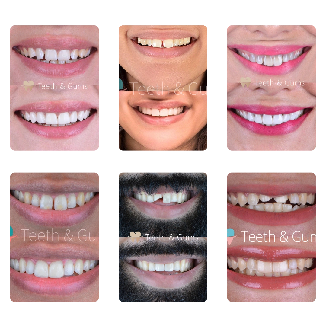 Veneers