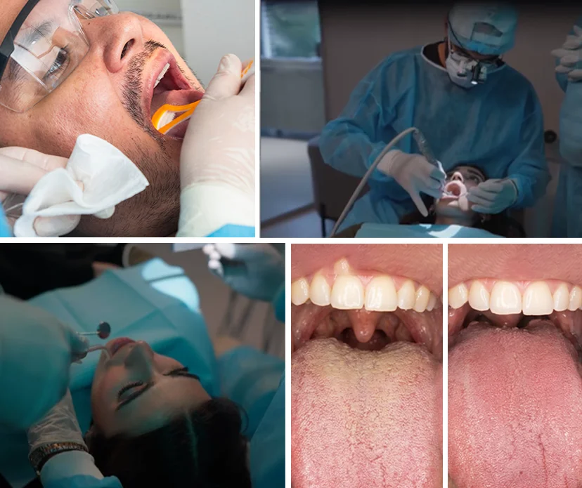Exploring Halitosis Bad Breath
