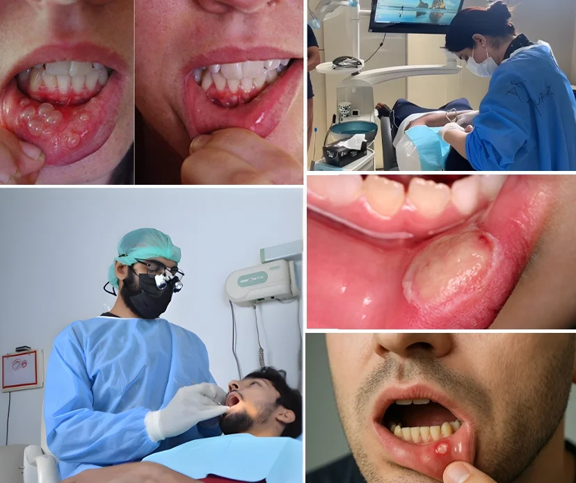 Exploring Mouth Ulcers