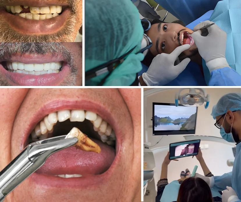 Exploring Tooth Extraction