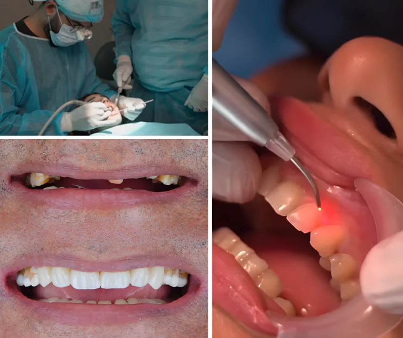 Understanding Chipped & Broken Tooth Treatment