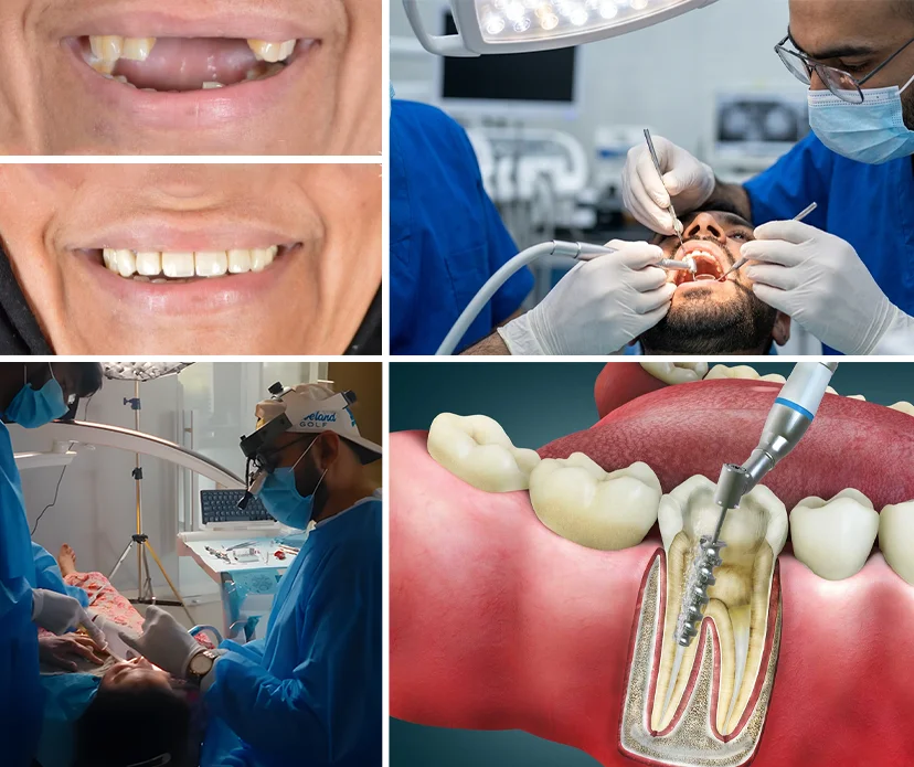 Understanding Root Canal Treatment